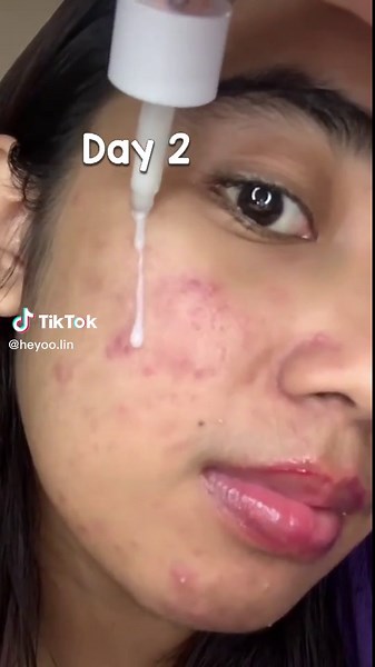 Jujur suka banget sama acne pure serum ini tiap bangun tidur kulit berasa halus #hempastanpabekas #acneserum #glowfx #getyourgloweffect