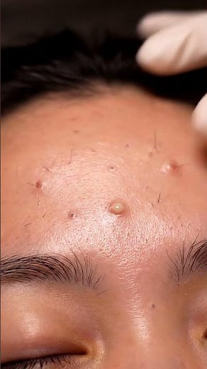 ASMR Dermatology: Ear-Front Blackhead Suction from Visible Pores 064