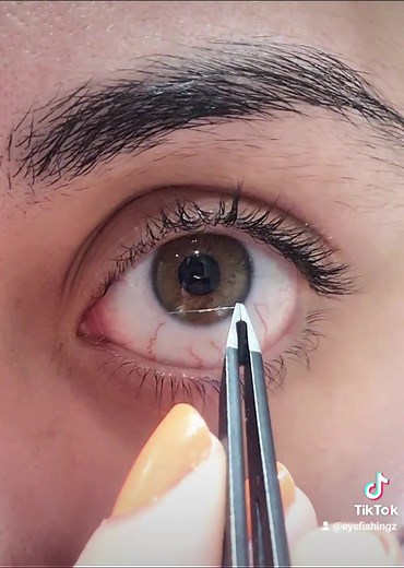 eye fishing syndrome-mucus removal #eyefishing #eyejunk #eyemucus #mucusfishingsyndrome
