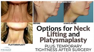 Options for a Platysmaplasty, and Temporary Feeling of Tightness after the Procedure