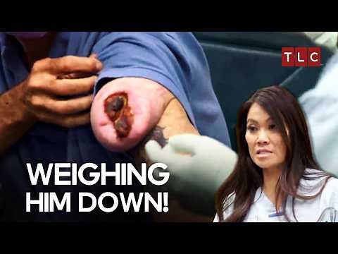When a Shoulder Bump Becomes a Beast! | Dr Pimple Popper TLC