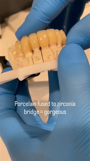 Dr. Daniel Kaye on Instagram: "We used a porcelain fused to zirconia bridge here to help restore a patients broken down premolars and canines. This is another great option if a patient is hesitant regarding surgical implants #zirconia #porcelain #porcelainfusedtozirconia #crowns #dentist"