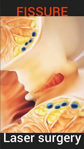 Fissure Treatment Laser Surgery