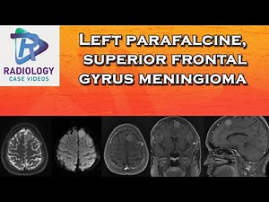 Left parafalcine , superior frontal gyrus meningioma