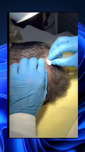 skincare squeeze pimple satisfying extraction explore popping (104)