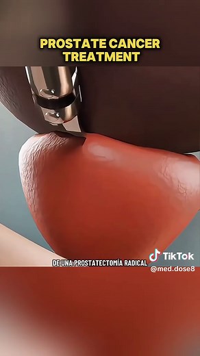 Understanding Prostate Cancer Treatment with 3-D Animation