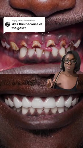 Importance of Dental Hygiene and Grill Removal for Healthy Teeth