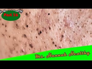 超大工程!!全臉肉芽+粉刺+粉瘤+血管瘤電燒清除+復原狀況 莊禮謙醫師#36