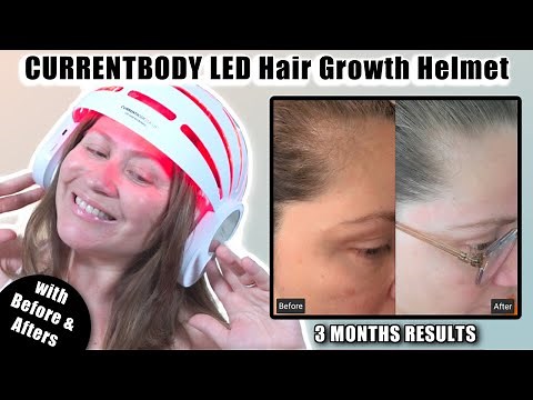 CurrentBody LED Hair Growth Helmet | 3 month results with before & afters