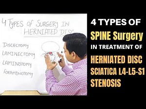 Lumbar Spine Surgery, L4-L5-S1-Herniated Disc, Canal Stenosis, Spinal Decompression, MICRODISCECTOMY
