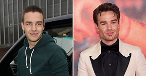 Did Liam Payne Get Plastic Surgery? Jaw, Face Photos