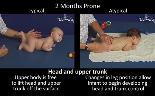 Is baby able to lift their head to 45 degrees at 2 months of age in the prone position or do they tend to shift their weight forward towards their head, making it harder to lift? Use this atypical and typical motor development video to help you recognize early motor delays. #WatchThisWednesday Remember to adjust for prematurity. If you have concerns, talk your healthcare provider. 𝗪𝐡𝐚𝐭 𝐢𝐬 𝐩𝐫𝐨𝐧𝐞? Lying on the stomach with the face downward (think of Tummy Time). ➡️ Watch the full video