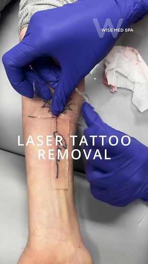 This patient is on session #2 of her laser tattoo removal! What you see being placed over the tattoo is a PFD (perfluorodecalin) Patch. It essentially helps the laser to better target the ink while protecting the skin, which allows for more passes. . . . #lasertattooremoval #tattooremoval #lasertattoo #lasertreatment #njlaser #njmedspa #waynenj