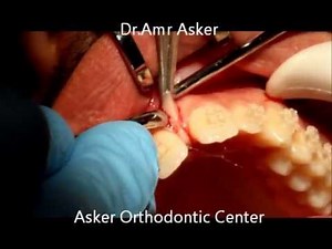 Frenectomy Labial - Midline Diastema Orthodontic Closure  • Video • MEDtube.net