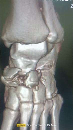 #fracture navicular bone ct scan cornal sagittal n 3d image