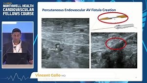AV Fistula Percutaneous Creation and Subsequent Procedural Management