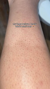 5.1K views · 3 comments | Say bye to strawberry skin just in time for spring skirts & shorts season  Those little red bumps? They’re caused by clogged pores or trapped hair follicles, but Lumi’s got you Our IPL device targets the hair at the root (literally), reducing regrowth and irritation for smoother, clearer skin with every flash ✨ Spring cleaning... but make it skincare. 識 Ready to have smooth healthy skin all year long? | Rose Skin Co | Facebook