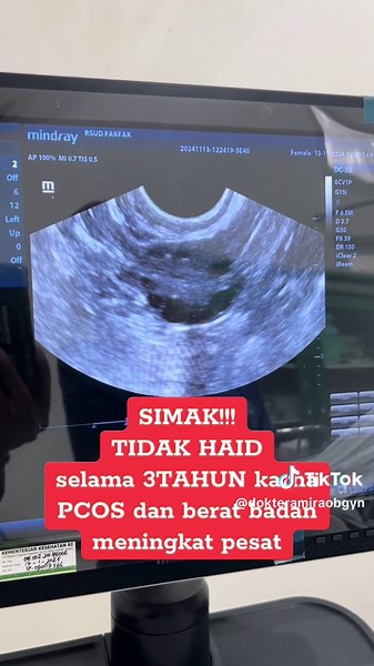 Tips Mengatasi Haid Tidak Teratur dan PCOS