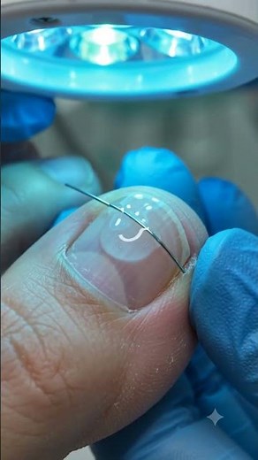 INGROWN TOENAIL! Titanium wire correction 👣