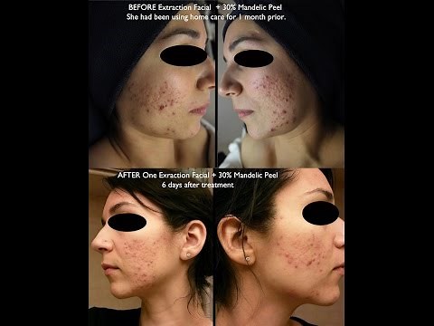 Professional Acne Extractions Pimple, Blackhead |Esthetician Aesthetician School