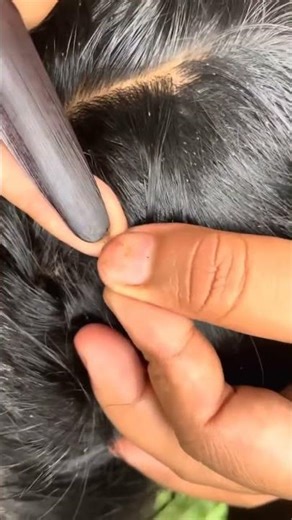 lice removed#lice #satisfying #animals #hair #pimple #extraction #blackheads