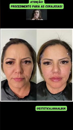 Tratamento de Lifting com Fios. Fios de sustentação facial, antes e depois.