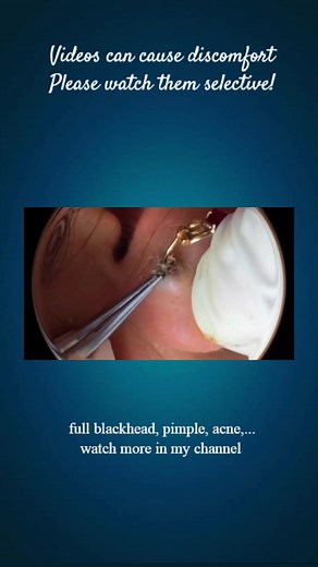 Big pimple blackhead removal #acne #pimple #blackhead #extractions #satisfying