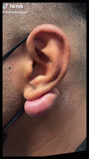 Keloid Removal and SRT Treatment by Sensus Healthcare