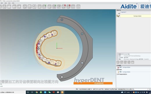 数字化义齿加工之Hyperdent软件种植长桥及90度垂直加工排版指导视频