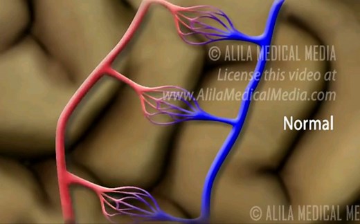 动静脉畸形（AVM）与栓塞治疗Arteriovenous malformation (AVM) and Embolization Treatment