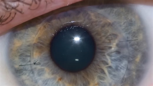 How a Soviet Spinning Experiment Accidentally Invented Laser Eye Surgery