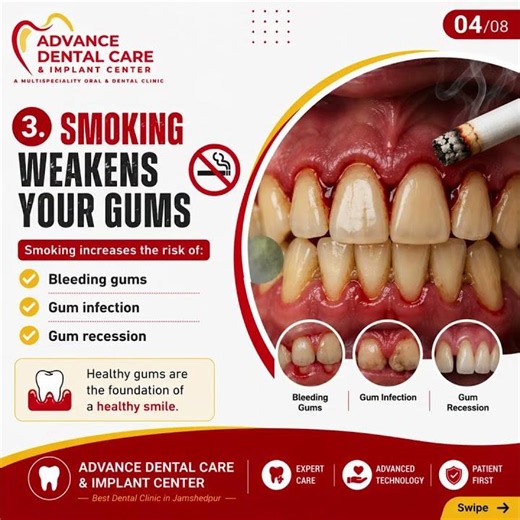 Smoking & Oral Health | How Smoking Damages Your Teeth & Gums | Best Dental Clinic in Jamshedpur
