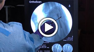 Retrograde Intramedullary Screw Fixation of a Metacarpal Shaft Fracture with Mihir Desai, MD