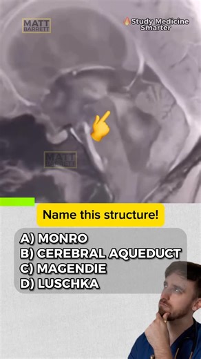 Dr Matt Barrett MBBS BSc | Study Medicine Smarter on Instagram: "⚠️ Tap here for the answer 🔍 Comment “OSCE” for FREE pages of Never Forget Clinical Exams - master your OSCEs and Vivas ✅ Spoiler alert: cerebral aqueduct The cerebral aqueduct (of Sylvius) connects the third ventricle to the fourth ventricle. It runs through the midbrain and is a classic site for blockage → leading to non-communicating hydrocephalus. 💡Obstruction here = dilated lateral and third ventricles, normal-sized fourth v