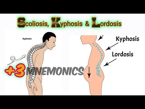 Lordosis, Kyphosis, and Scoliosis