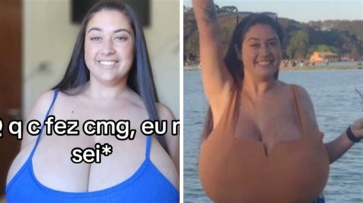 ‘My breasts grew uncontrollably every month’