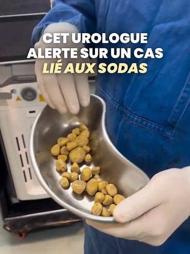 Coca-Cola: 2-3L/jour, calculs rénaux
