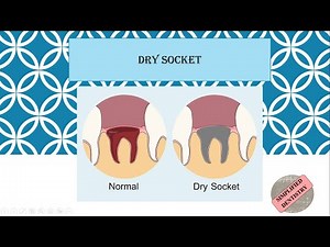 Dry Socket