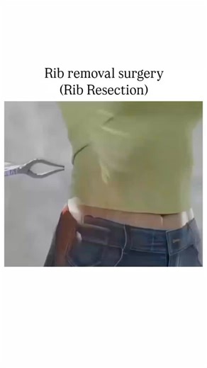 Science on Instagram: "Rib removal surgery, also known as rib resection, is a medical procedure where one or more ribs are partially or completely removed. It is usually done to treat conditions like thoracic outlet syndrome, severe trauma, or bone cancer, but in some rare cases, it may also be performed for cosmetic purposes. The surgery helps relieve pressure on nerves or blood vessels and improves overall function and comfort. . . . #RibResection #RibRemovalSurgery #MedicalProcedure #SurgeryE