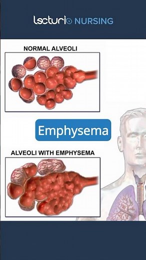 Exploring Emphysema 🔍 #Emphysema #RespiratoryCare #nclexrn