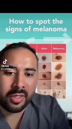 Understanding the ABCDs of Melanoma: Differentiating Between Moles and Skin Cancer