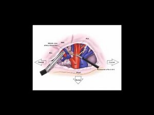 STS University Course 7: VATS Lobectomy