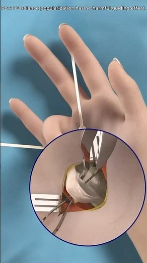 Trigger finger (3D animation) #finger #surgery #3Danimation #doctor