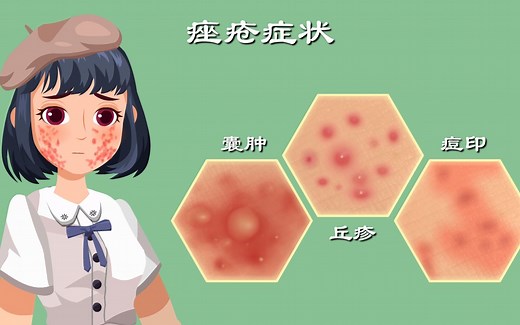 痤疮1：“痘痘”为啥长你脸上