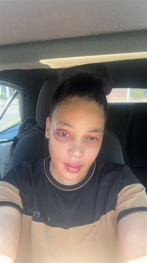 Understanding Necrotizing Fasciitis and Healing Processes