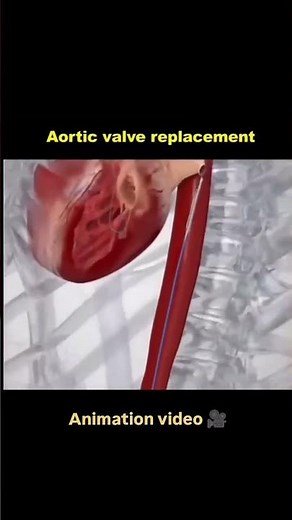 How does a Transcatheter Aortic Valve Replacement (TAVR) actually work? 🫀🔬