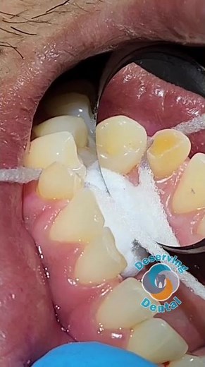 SDF~ cavity obliteration technique with super floss for interproximal decay.