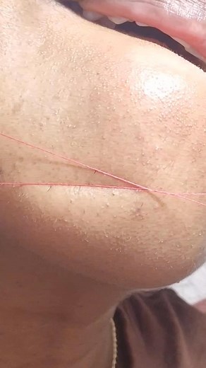 13K views · 41 reactions | Follow for more #threading #hairremoval #satisfying #pcos #chin #satisfying #beautycare #beauty #threadinghairremoval ##hairremoval | threading hairs | Facebook