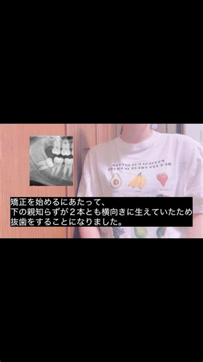 横向きの親知らずを抜歯しました
