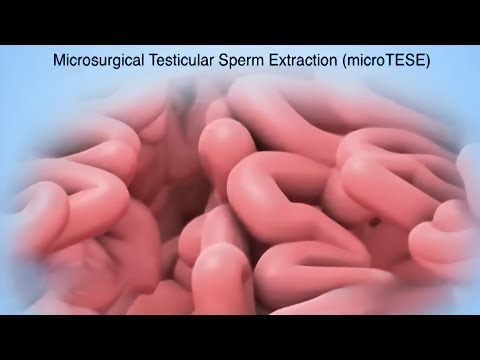 Microsurgical Testicular Sperm Extraction | Micro-TESE #doctor #medical #education #video #animation